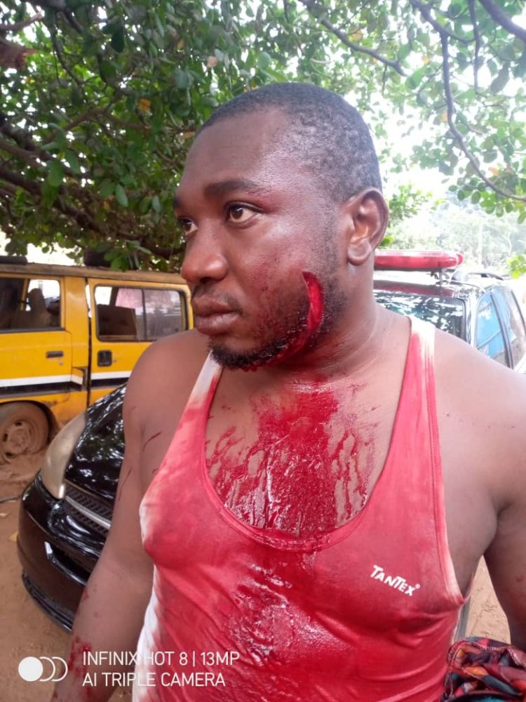 In Anambra, Amansea Prince Narrowly Escapes Death After Bloody Attack 